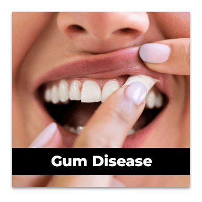 Gum disease from nicotine pouches